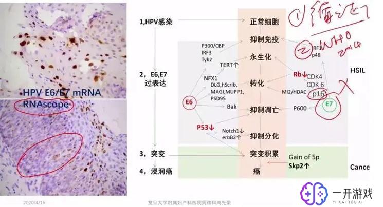 鳞状上皮细胞异常是什么意思,鳞状上皮细胞异常解析