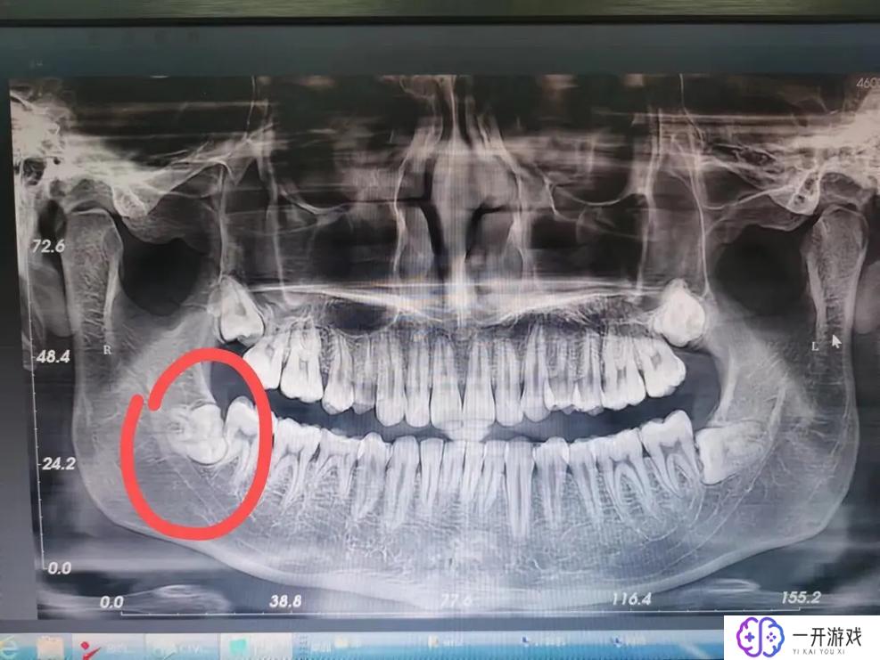 拔智齿需要拍ct吗,拔智齿拍CT有必要吗？看这篇就懂了