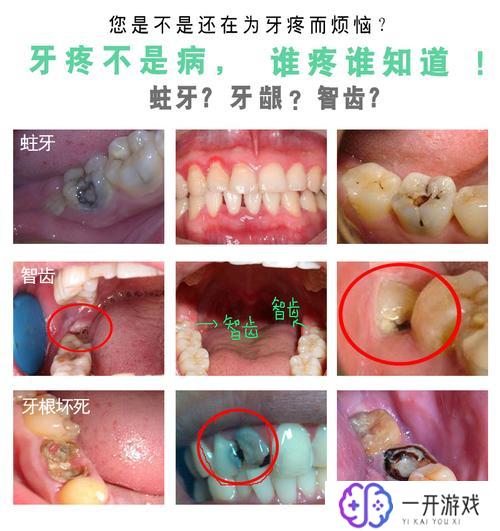 发炎可以拔智齿吗,智齿发炎，拔牙时机适宜吗？